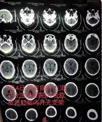 脑供血不足检查报告图片