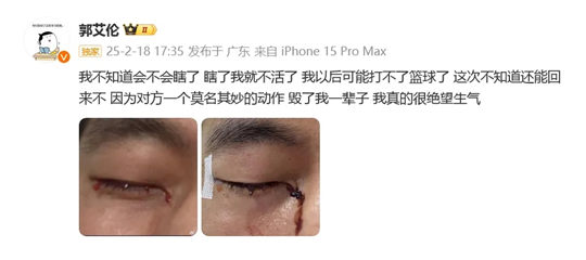 郭艾倫訓(xùn)練時被隊友戳傷眼部，責(zé)任應(yīng)當(dāng)如何判定？